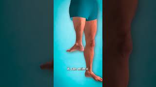 What is a rotationplasty shorts [upl. by Eldreda]