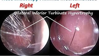 Nose Endoscopy  Rhinitis Medicamentosa Drug Induced RhinitisTopical Nasal Decongestants [upl. by Service]