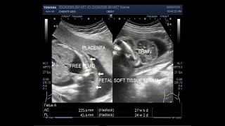 Ultrasound Video showing Hydrops fetalis Anencephaly Soft tissue edeme ascites and club foot [upl. by Punak]