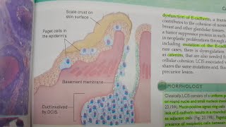 Preinvasive and Invasive Ductal and Lobular Breast Carcinoma Part 2  SPECIAL PATHOLOGY [upl. by Chloe]