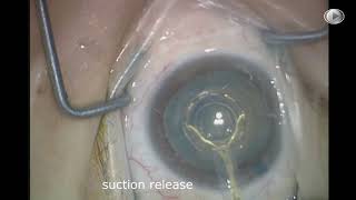 Dr David Chang ZEPTO® Capsulotomy in a Mature White Cataract [upl. by Suiratnod]