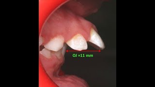 Amazing two phase treatment of Sever Class II Div 1  lama 10Y [upl. by Wolfie255]