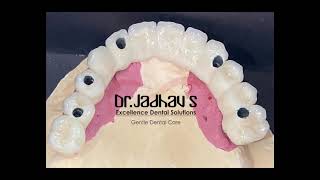 All teeth fixed by Dental Implants by Dr Vivek Jadhav [upl. by Staten]