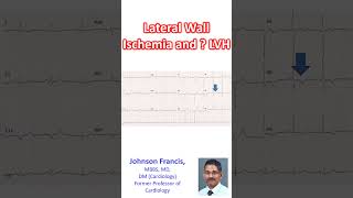 Lateral Wall Ischemia and LVH [upl. by Shore]