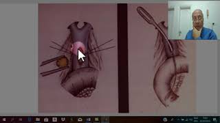 Biliary surgery 18  Obstructive jaundice  part 6   by Dr Wahdan [upl. by Sivlek250]