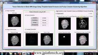 Tumor Detection in Brain MRI Image Using Template based Kmeans and Fuzzy Cmeans Clustering MATLAB [upl. by Atinit]