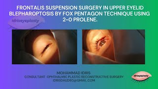 Frontalis suspension surgery in upper eyelid blepharoptosis using 20 prolene [upl. by Sefton]