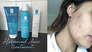 La RochePosay HORMONAL ACNE Treatment ➳ My Experience [upl. by Neelahs]