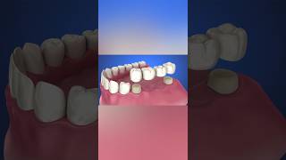 Tooth supported fixed bridge instalation process medicalanimation health dentist [upl. by Inavoj]