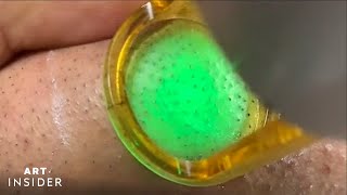 Laser Zaps Out Ingrown Hairs  Art Insider [upl. by Reina]