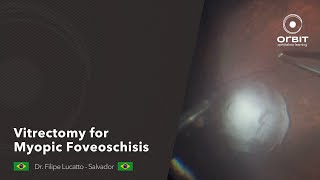 Orbit tips 046  Vitrectomy for Myopic Foveoschisis [upl. by Bertolde]