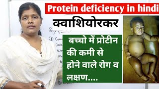 What is protein deficiency kwashiorkor in hindi  क्वाशियोरकर symptoms amp causes  ranjana [upl. by Geller]