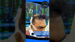 Dht hair transplant Bangalore tamilanht [upl. by Mervin]