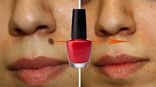 Nail Paint से तिल  मस्से और दाग ऐसे गायब होंगे जैसे कभी थे ही नहीं 100 Working  Remove Moles [upl. by Bekah]