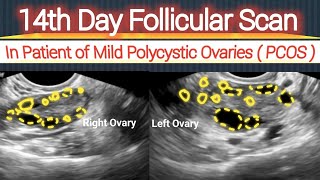 14th Day Follicular Scan  in Patient of Mild Polycystic Ovaries  PCOS [upl. by Frazer]