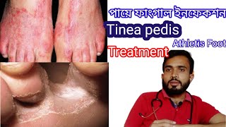 Athletis Foot  Tinea Pedis  cause symptomtreatment [upl. by Naihr]