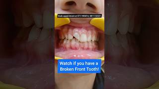 Broken Front Tooth Fix it NOW Dr Srishti Bhatia teeth dentist [upl. by Auqinihs]