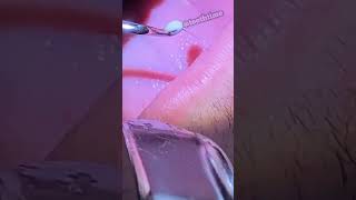 Deep Tonsil Stone Removal  Tonsil Stones  Tooth Time Family Dentistry New Braunfels Texas [upl. by Ytirahc]