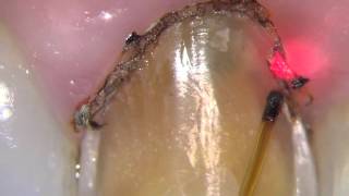 Soft tissue remodeling and recover with diode laser in central incisor laminate preparation [upl. by Bowles214]