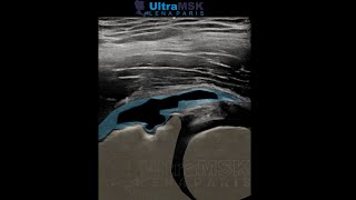 Como evaluar una lesión del labrum anterosuperior de la cadera en ultrasonidoecografía Dra Pari [upl. by Yevi]