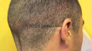 FUE transplant by Dr Reddy  Norwood 3 hair loss 1207 grafts [upl. by Ynnelg]