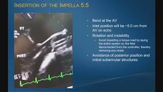 Impella 55 with SmartAssist Implantation Experience [upl. by Akinor]