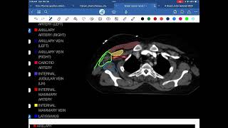 Axillary Lymph node 1 contouring [upl. by Owain]