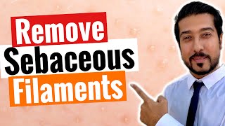 Sebaceous Filaments  3 Steps to Get Rid of Sebaceous Filaments FAST [upl. by Leirda]