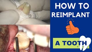 Intentional REIMPLANTATION of a TOOTH  Extraction and replacement in its socket  Live surgery [upl. by Cort]