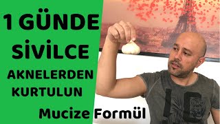 Sivilce ve Aknelerden 1 Günde Kurtulun  Sivilce ve Aknelere Bitkisel Kesin Çözüm [upl. by Golanka]