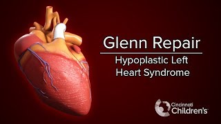 Medical Animation Glenn Operation  Cincinnati Childrens [upl. by Sibie]