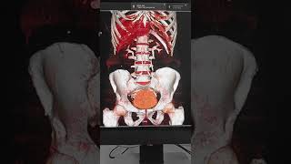 CT Urogram 3D image [upl. by Llenor]