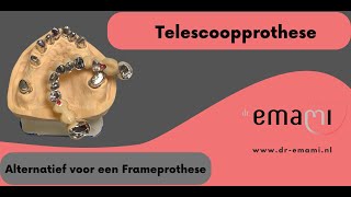 Telescoopprothese Frameprothese Kunstgebit [upl. by Joyann]