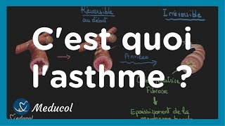 Lasthme cest quoi physiopathologie causes symptômes et traitement [upl. by Ahcarb303]