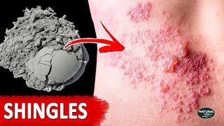 How to Get Rid of Shingles  Shingles Treatment at Home [upl. by Ayikin]