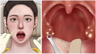 ASMR 입냄새의 원인 편도결석 제거 애니메이션  Cause of bad breath Tonsil stone removal animation [upl. by Annahahs]