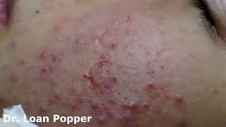 Acne Blackheads Whiteheads removals on face part 8 [upl. by Nhguavahs679]