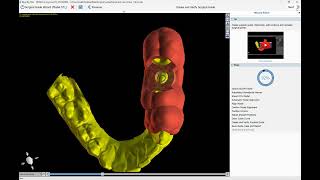 BSPV411 Crown Down Implant Planning with Immediate Load Crown Design [upl. by Adnot]