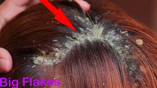 BIG DANDRUFF FLAKES Scalp scratching and picking Satisfying Dandruff Removal  12 [upl. by Venu153]