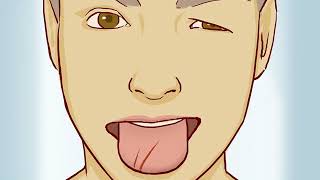 How to Stop Tongue Bleeding [upl. by Richart]