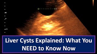 Liver Cysts Explained What You NEED to Know Now [upl. by Araiet]