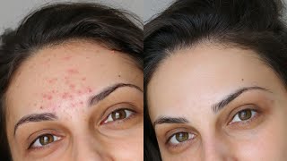 How to use Benzoyl Peroxide gel Dr Ashima Goel Parisa Skin clinic Acne Treatment in Chandigarh [upl. by Aspa]