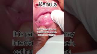 Lingual Bubble ranula oralpathology education salivarycyst health dentistryknowledge tongue [upl. by Paviour]