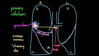 Primary and Secondary TB [upl. by Zendah]