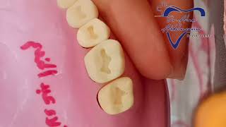 class 1 cavity preparation for upper 6 for amalgam restoration  شرح بسيط ومفصل بالعربي [upl. by Anuahsed218]