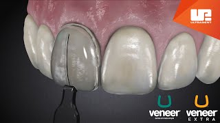 Uveneer® Procedure Animation  Direct Veneer Template System [upl. by Ecyoj]