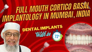 Full mouth cortico basal implantology in mumbai Best corticobasal implants in mumbai [upl. by Gomez]