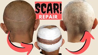 Hair Transplant Results  FUT Hair Transplant Scar  Scar Revision [upl. by Baldridge]