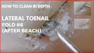 How to clean in depth lateral toenail fold 6 After beach [upl. by Ibbor]