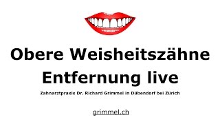 Weisheitszahnextraktion Zürich live Entfernung von 2 oberen Weisheitszähnen [upl. by Eatnohs449]